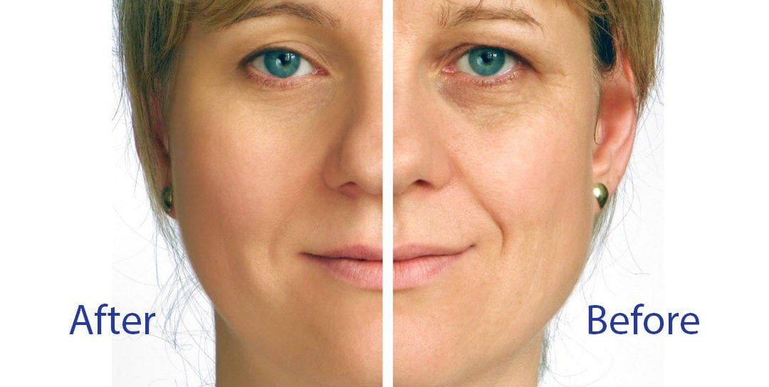 Strength Training for Your Face: The Turbo Lift