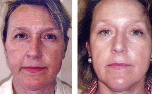 The Turbo Lift by Emily Fritchey, The Skin Whisperer