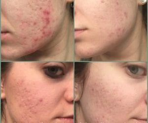 Skin Cleansing: The Missing Link in Corrective Skin Care