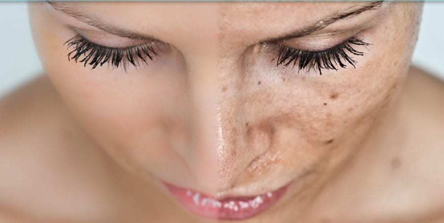 Photoaging: Solutions and Strategy for Hyperpigmentation and Sun Damaged Skin