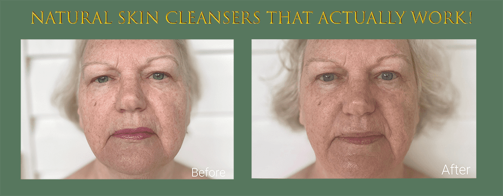 Linda Ramey Before and After Results from Sunshine Botanicals Double Cleanse process