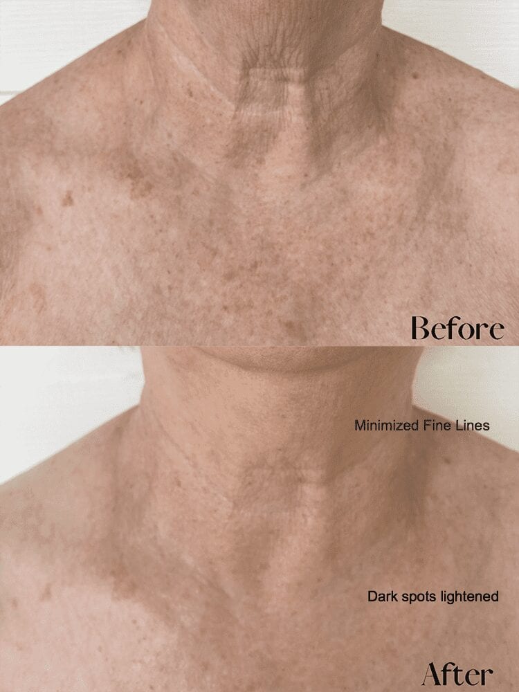 Linda Décolletage before and after Linda Décolletage before and after