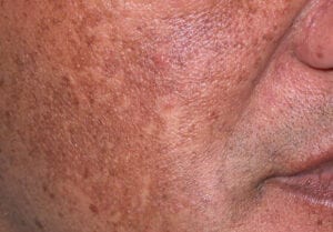 hyperpigmentation and blotchy skin