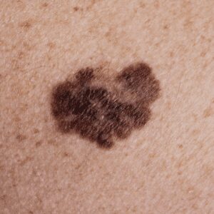 Emily Fritchey Sunshine Botanicals Check your moles