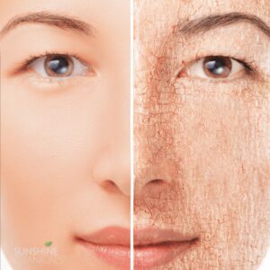 Dry Skin 
