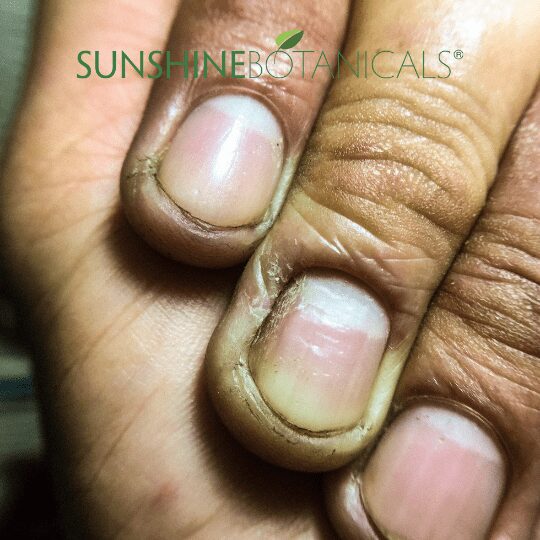 Dry Skin fingers