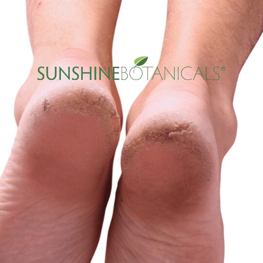 Skin Fissures heals
