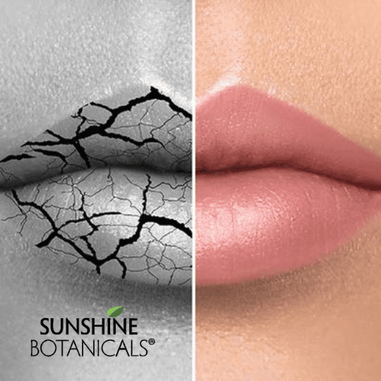 Chap Lips Crack lips - use rapid repair balm from sunshine botanicals