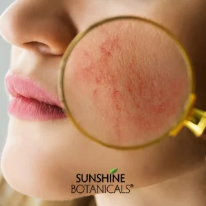 In addition, the cold, dry air can strip away the skin's natural moisture, leaving it feeling tight, itchy, and prone to irritation and conditions such as dermatitis and eczema. 